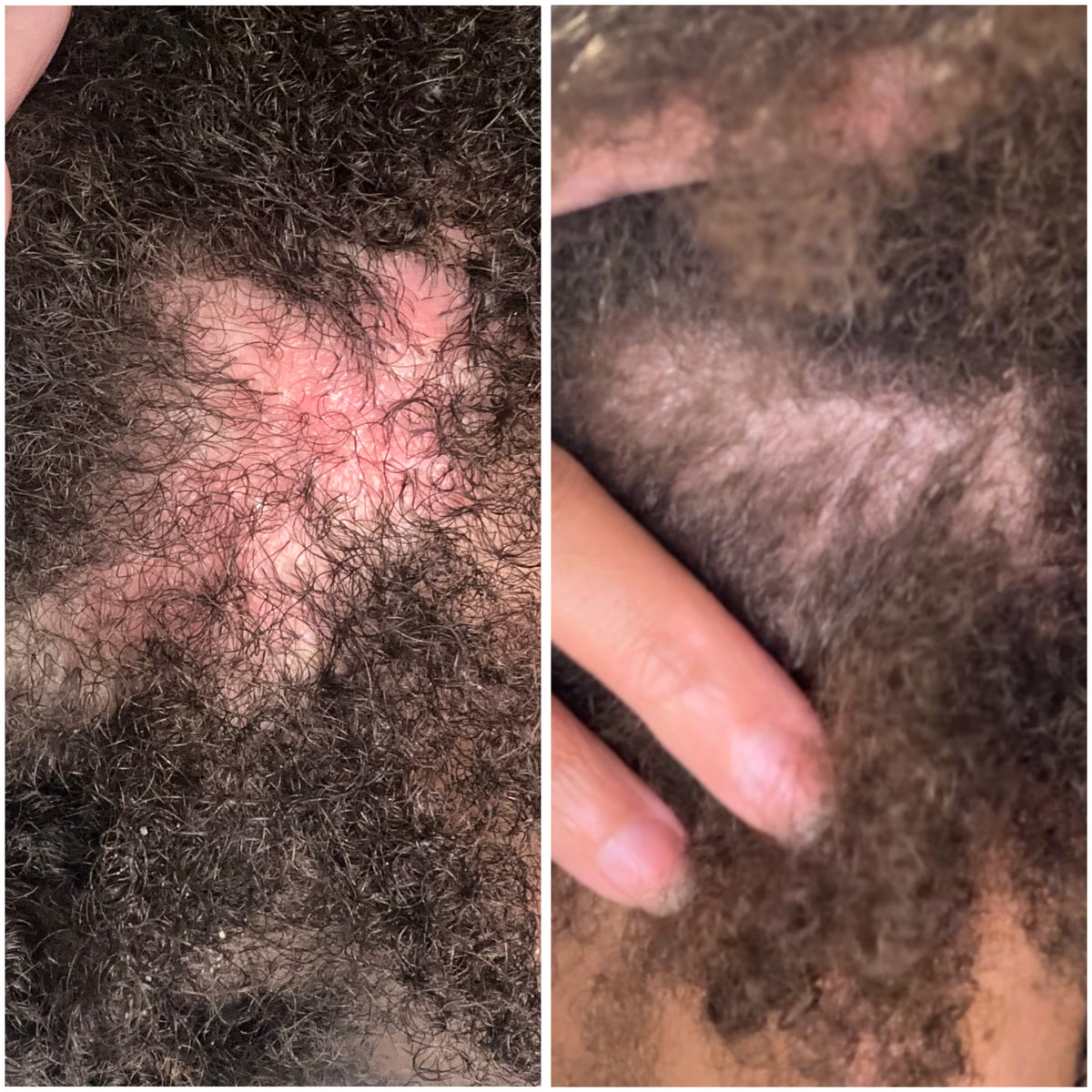 Scalp and curly hair texture with visible skin at the hairline
